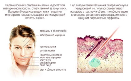 Biorevitalizarea feței este cel mai bun remediu pentru întinerirea pielii