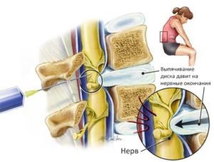 Blocarea coloanei vertebrale cu hernie este periculoasă, câte acte