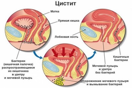 Boli ale sistemului genito-urinar la femei