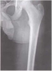 Durerea la extremitatea inferioară a osteomului-osteomului șoldului