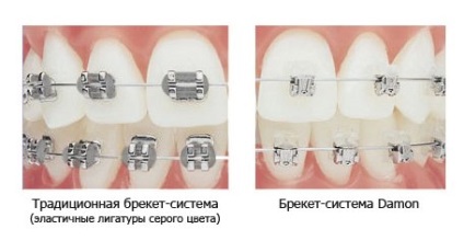 Suportul sistemului Damon q, caracteristicile sale, balena albă pentru stomatologie