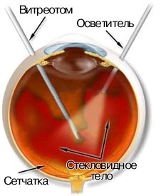 Retinopatie diabetică