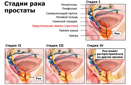 Dieta în recomandările pentru cancerul de prostată