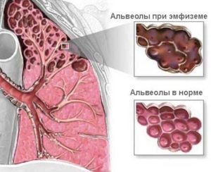 Gimnastica respiratorie cu emfizem pulmonar