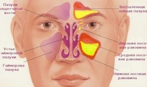 A paranasalis sinusok leeresztése egy sinus katéteren keresztül - egy aqualoclinic klinika