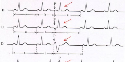 Indicatorii ECG la adulți, cu decodificare și normă