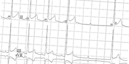 Indicatorii ECG la adulți, cu decodificare și normă