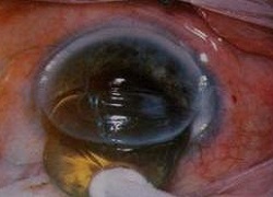 Extragerea extracapsulară a cataractei (eek) cu implantare IOL - chirurgie cataractă -