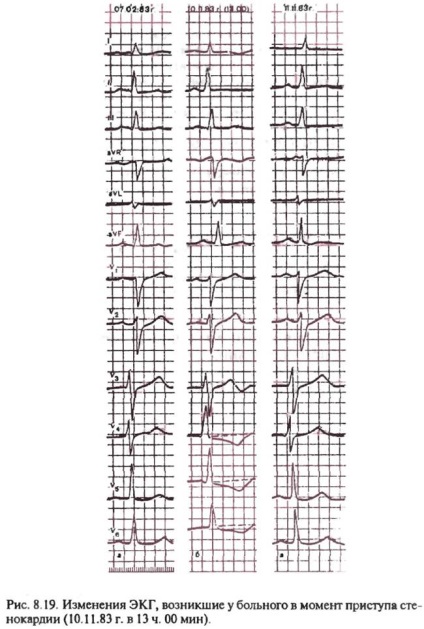 Electrocardiograma pentru un atac de stenocardie