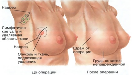 Fibroadenomul sânului care este și modul de tratare, tipare
