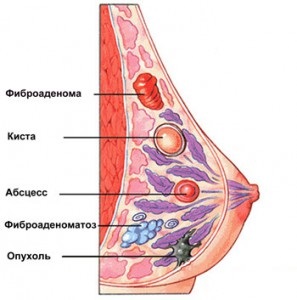 Fibroadenomul glandei mamare - care este un diagnostic atât de periculos de fibroadenom al sângelui drept și stâng