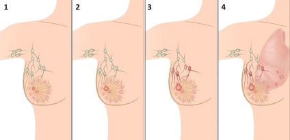 Fibroadenomul sânului care este și modul de tratare, tipare