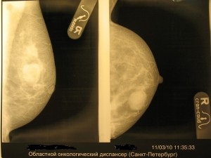 Fibroadenomul glandei mamare - care este un diagnostic atât de periculos de fibroadenom al sângelui drept și stâng