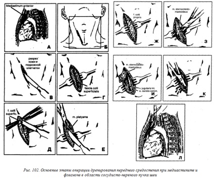 Phlegmon cellulóz mediastinum (mediastinitis) - jó fogászati ​​portál, jó