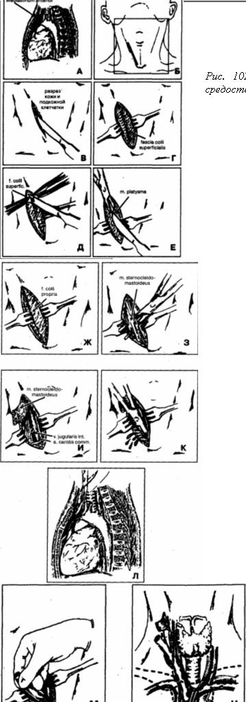 Phlegmon fiber mediastinum (mediastinitis) - maxillofacialis sebészet, tályogok, fonálfej