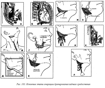 Phlegmon cellulóz mediastinum (mediastinitis) - jó fogászati ​​portál, jó