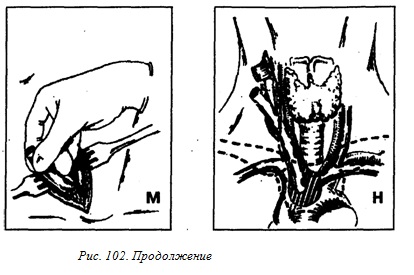 Phlegmon cellulóz mediastinum (mediastinitis) - jó fogászati ​​portál, jó