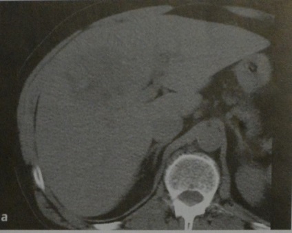 Carcinomul hepatocelular (HCC)