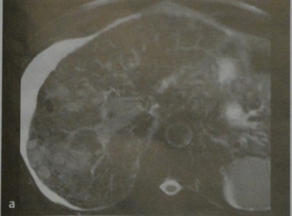 Carcinomul hepatocelular (HCC)