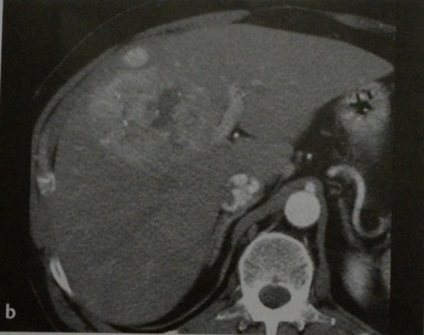 Carcinomul hepatocelular (HCC)