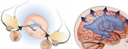 Hidrocefalia la copii - ceea ce este, simptomele, tratamentul, cauzele, prognosticul, rezultatul și durata