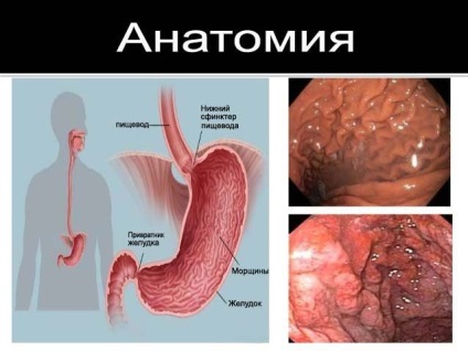 Gastrita hipertrofică gigantică (boala de menținere)