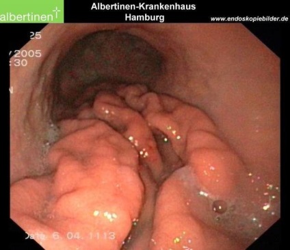 Giant hypertrophic gastritis (járványos betegség)