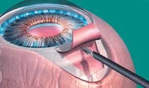 Glaucoma kezelés moszkvában - kezelési módszerek