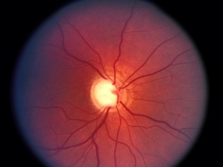 Glaucomul este centrul oftalmologic al profesorului de bazin