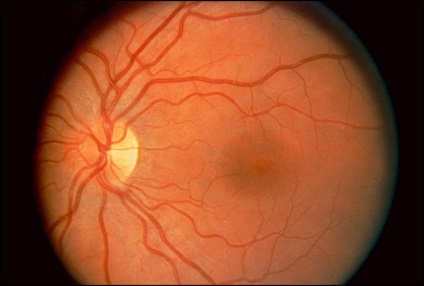 Glaucomul este centrul oftalmologic al profesorului de bazin