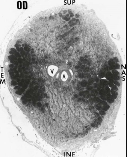 Glaucomul este centrul oftalmologic al profesorului de bazin