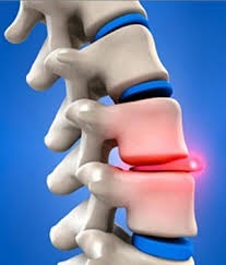 Herniile toracice ale simptomelor coloanei vertebrale, metodele de diagnosticare, tratament