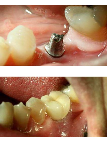 Implantarea tipurilor de dinți și a prețurilor la Moscova, implanturi dentare, implanturi la cheie