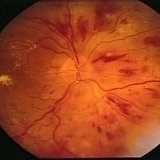 A szem retinájának megváltozása megnövekedett koponyaűri nyomás esetén - orvosa aibolit