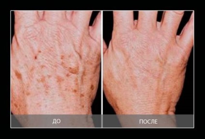Cum să întineri pielea feței întinerirea mâinilor, zona ochilor