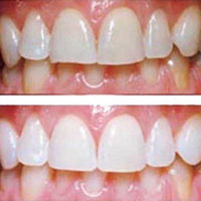 Cum să vă albiți dinții acasă fără a afecta smalțul
