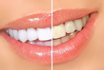 Hogyan lehet fehéríteni a fogakat otthon