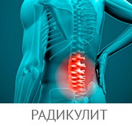 Kifoza coloanei vertebrale - cauze, simptome, tratament, prevenire, complicații