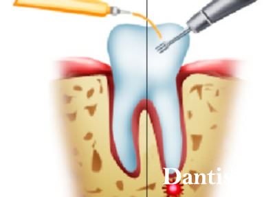 Ciszt a fogak tüneteire, hatásaira és kezelésére