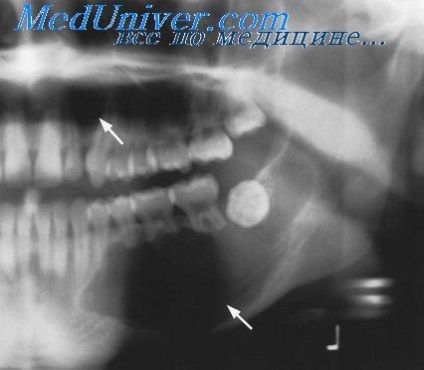 Chisturile fălcilor - clasificare, diagnostic, tratament