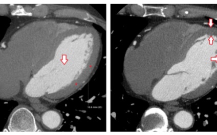 Tomografia computerizată a inimii, tehnica vaselor principale, normă, exemple