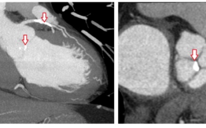 Tomografia computerizată a inimii, tehnica vaselor principale, normă, exemple