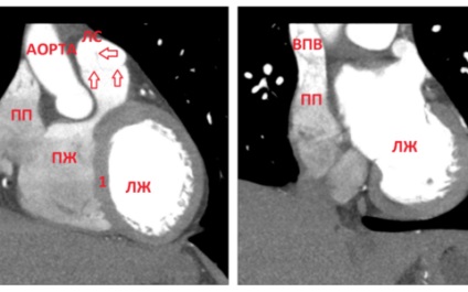 Tomografia computerizată a inimii, tehnica vaselor principale, normă, exemple