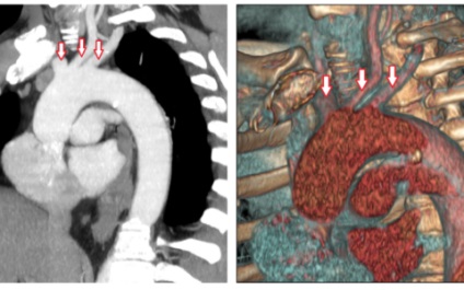 Tomografia computerizată a inimii, tehnica vaselor principale, normă, exemple