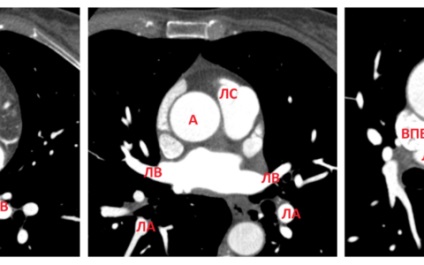 Tomografia computerizată a inimii, tehnica vaselor principale, normă, exemple