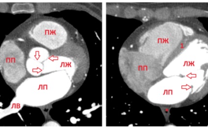 Tomografia computerizată a inimii, tehnica vaselor principale, normă, exemple