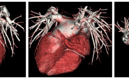 Tomografia computerizată a inimii, tehnica vaselor principale, normă, exemple