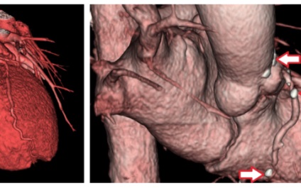 Tomografia computerizată a inimii, tehnica vaselor principale, normă, exemple