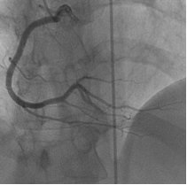 Angiografia coronariană, dcb im