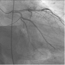 Angiografia coronariană, dcb im